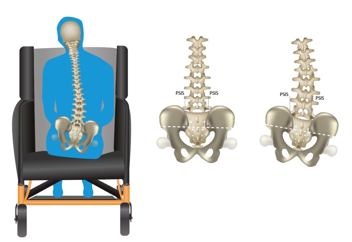 Pelvic Obliquity Diagram