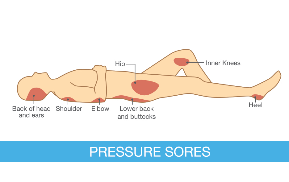 Diagram of various pressure sore types